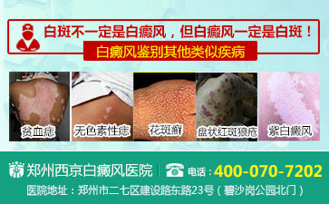 怎么才能更好的做好白癜风预防呢 怎么才能更好的做好白癜风预防呢