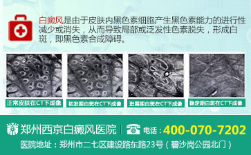 容易诱发儿童白癜风的病因是什么 形成白癜风的病因有哪些呢